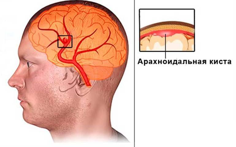 Киста головного мозга