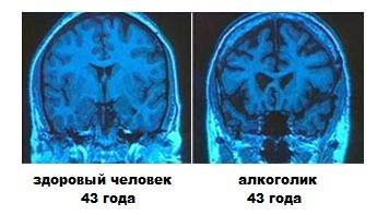 Перинатальная энцефалопатия у детей: симптомы, лечение, последствия во взрослой жизни