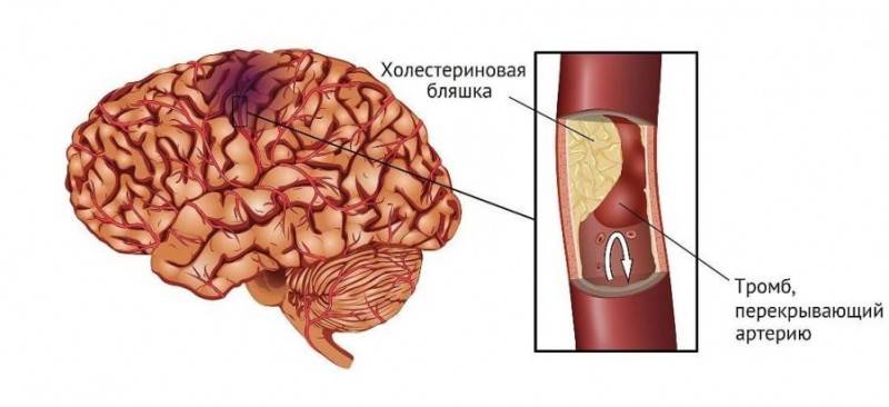 Бляшки в сосудах головного мозга