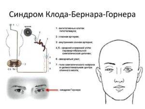 Опухоль спинного мозга, симптомы рака и диагностика онкологии, прогноз, сколько живут