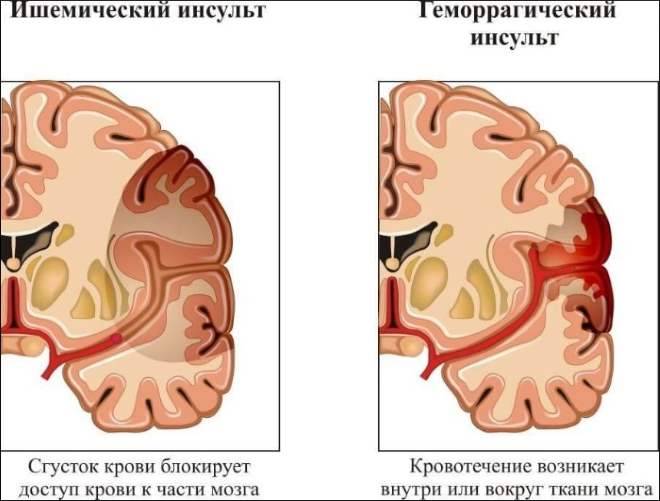 Инсульт мозжечка головного мозга. Причины, последствия, восстановление после инсульта в мозжечке