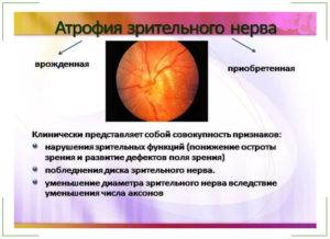 Атрофия зрительного нерва частичная и полная