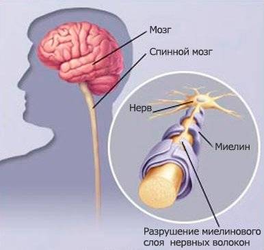 Атеросклероз сосудов головного мозга симптомы и лечение