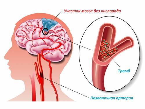 Ишемия сосудов головного мозга