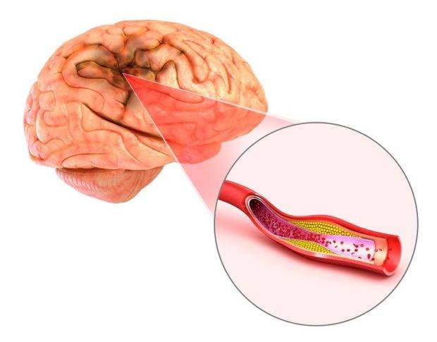 Атеросклероз сосудов головного мозга: причины, симптомы и лечение