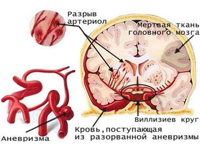 Аневризма сосудов головного мозга. Причины, симптомы, признаки, диагностика и лечение патологии