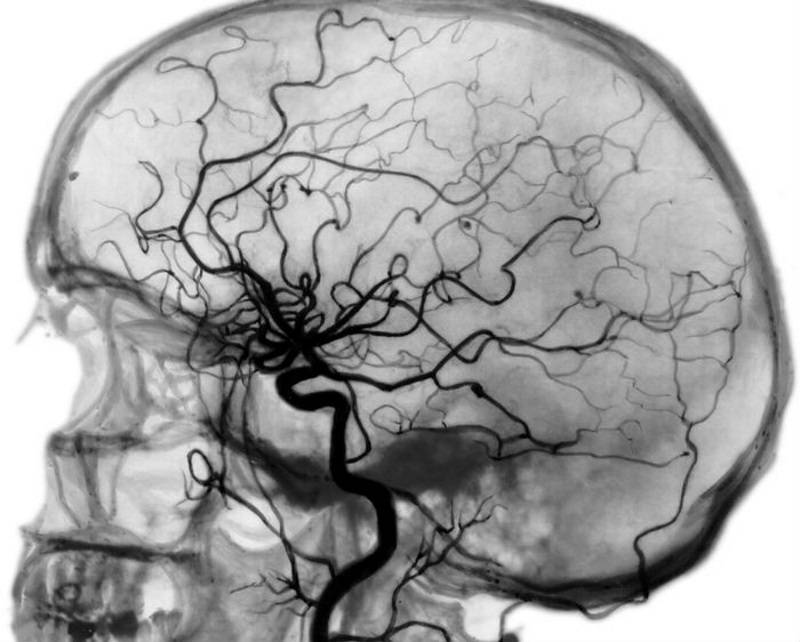 Диагностика МРТ сосудов головного мозга