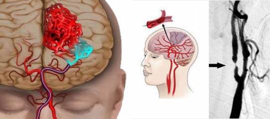 Ишемия сосудов головного мозга