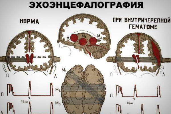 Эхоэнцефалография Эхо Эг головного мозга: что это такое Описание метода и расшифровка эхоэнцефалограммы