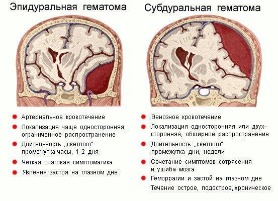 Гематома головного мозга