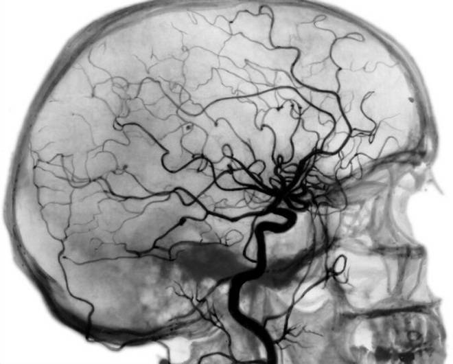 Ангиография сосудов головного мозга и шеи МР и КТ