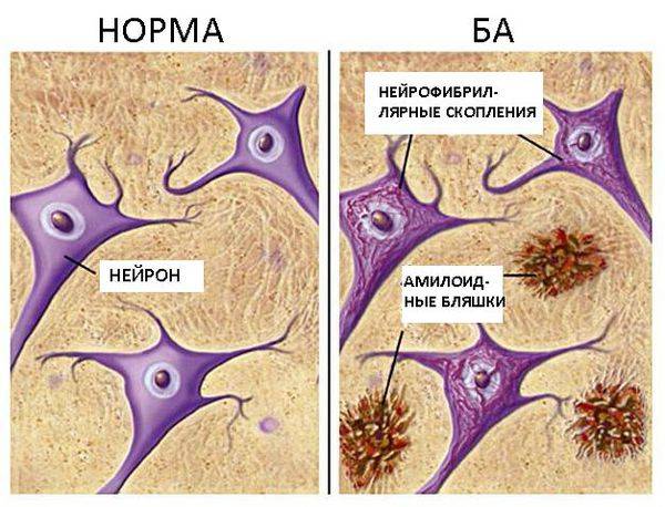 Клинико-психологическая характеристика деменции и дементивных расстройств