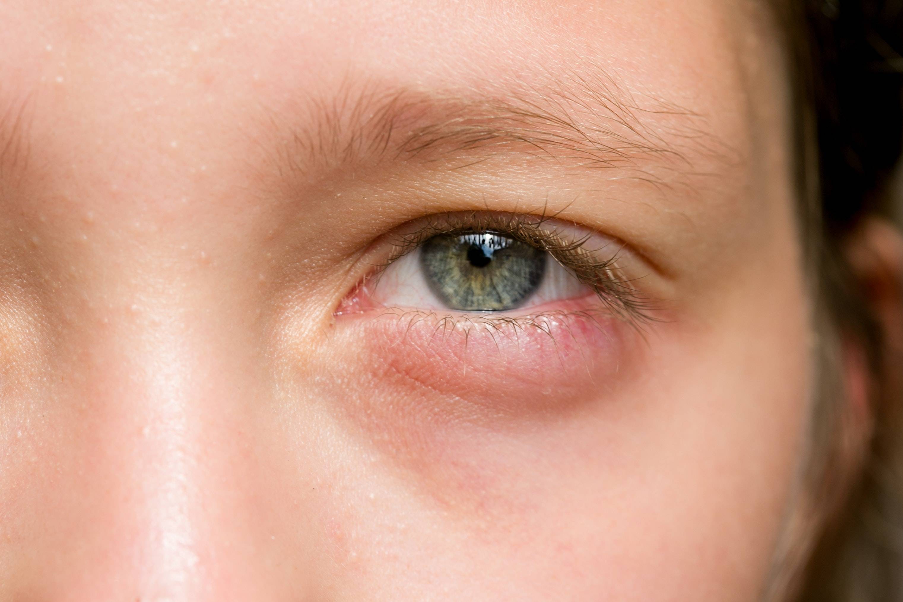 Покраснение глаза у ребенка причины и лечение фото