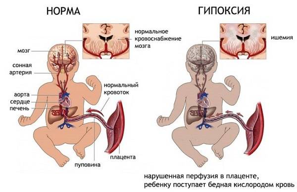 Гипоксия у новорождённых: признаки патологии, профилактические меры и курс лечения для грудничка