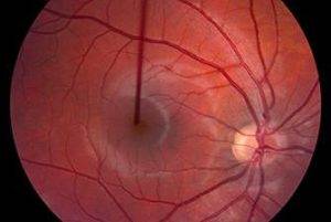 Атрофия зрительного нерва частичная и полная