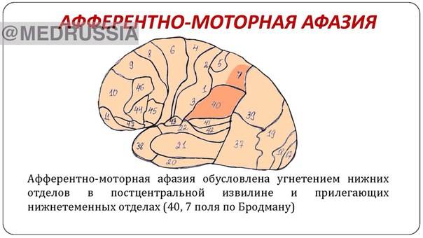 Причины и признаки моторной афазии