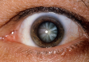 Пелена в глазах: причины и лечение