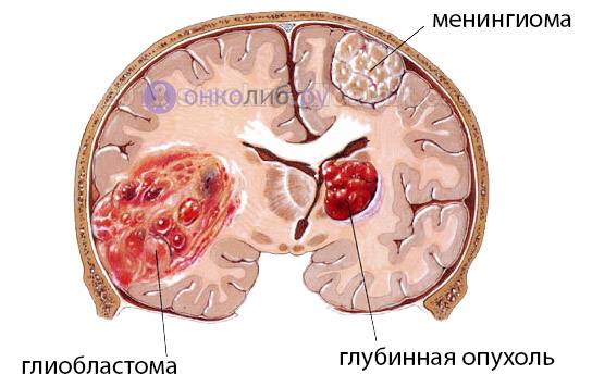 Менингиома головного мозга: виды патологии, методы лечения, прогноз и возможные последствия