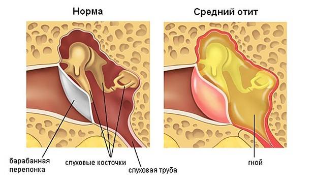 Гул в ушах: причины, почему гудит, симптомы и лечение