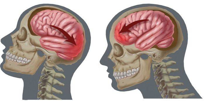 Неврология острой черепно-мозговой травмы