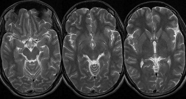Опухоль головного мозга последствия после операции
