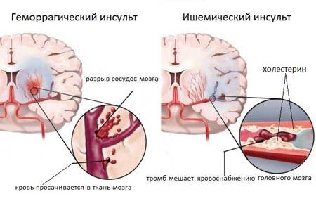 Лечение пациентов после инсульта с правосторонним параличом