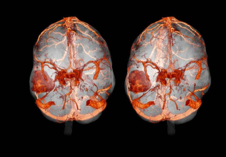 МРТ головного мозга: как проводят, показания и противопоказания