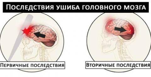 Закрытая черепно-мозговая травма сотрясение головного мозга, ушиб головного мозга, внутричерепные гематомы и т.д.