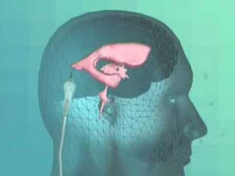 Виды операций по удалению опухолей головного мозга