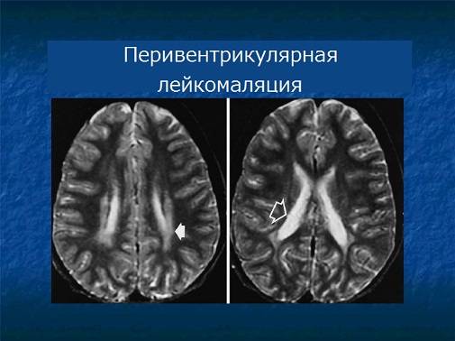 Структурные изменения головного мозга при гипоксически-ишемическом поражении центральной нервной системы у новорожденных разного гестационного возраста. Сопоставление эхографической картины с данными морфологических исследований