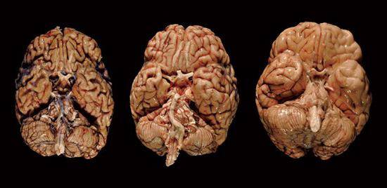 Неврология острой черепно-мозговой травмы
