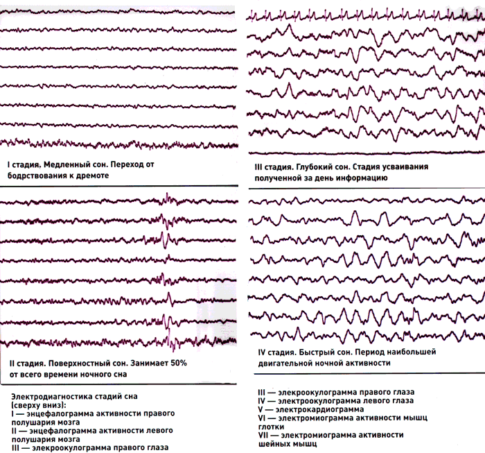 Ээг сна. Фазы медленного сна ЭЭГ. Стадии сна ритмы ЭЭГ. Стадии медленного сна на ЭЭГ. Ритмы ЭЭГ В фазу медленного сна.
