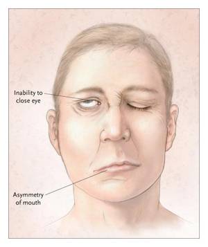 Как быстро вылечить невралгию воспаление лицевого нерва