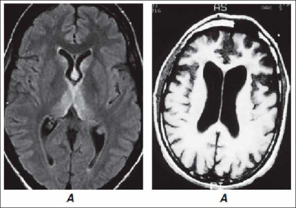 Энцефалопатия головного мозга: что это такое, лечение и последствия заболевания