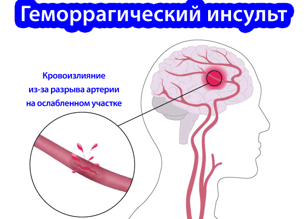 Ишемический инсульт прогноз для жизни